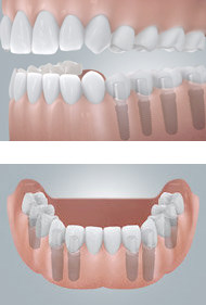 Zahnimplantate im Backenzahn- und Frontzahnbereich